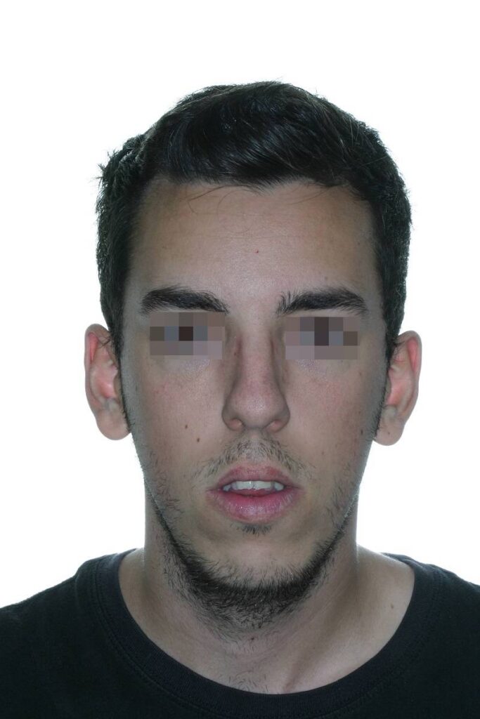 caso mordida abierta