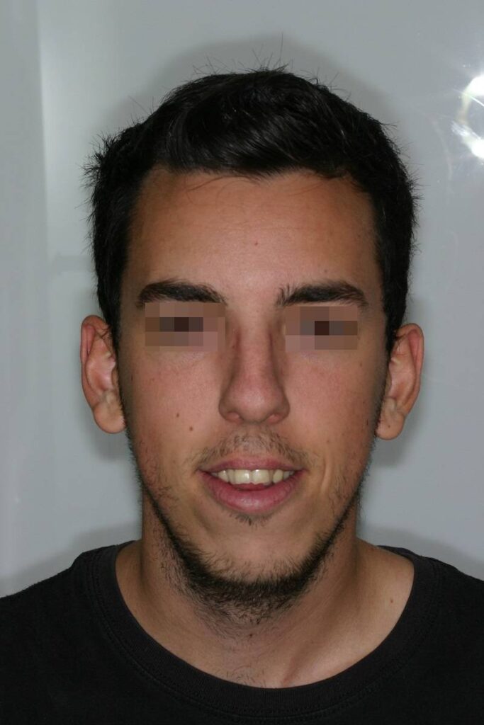 caso mordida abierta