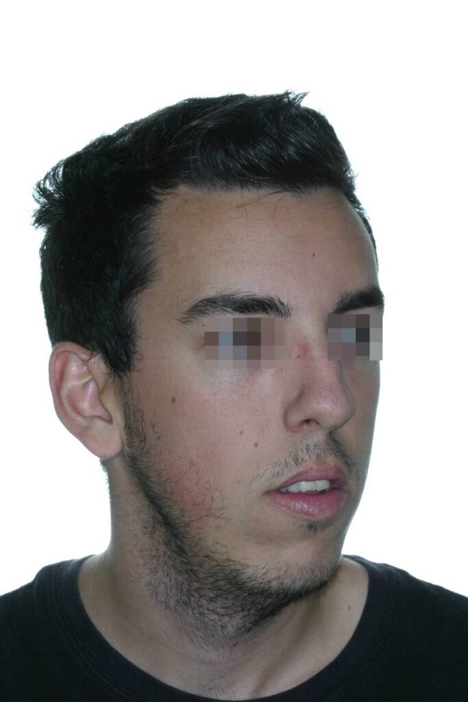 caso mordida abierta