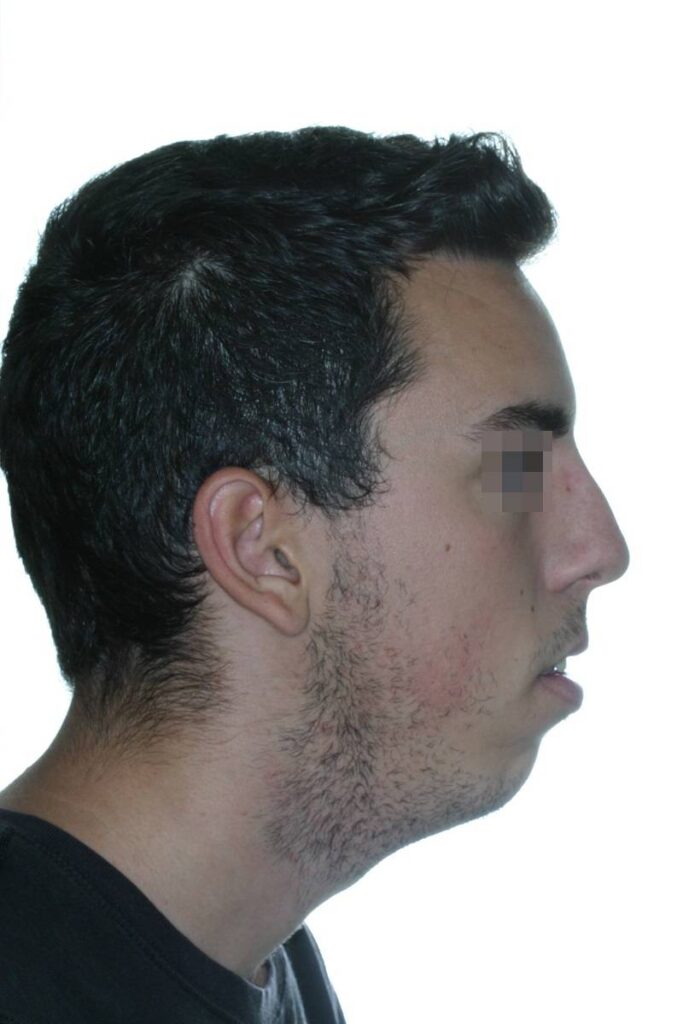 caso mordida abierta