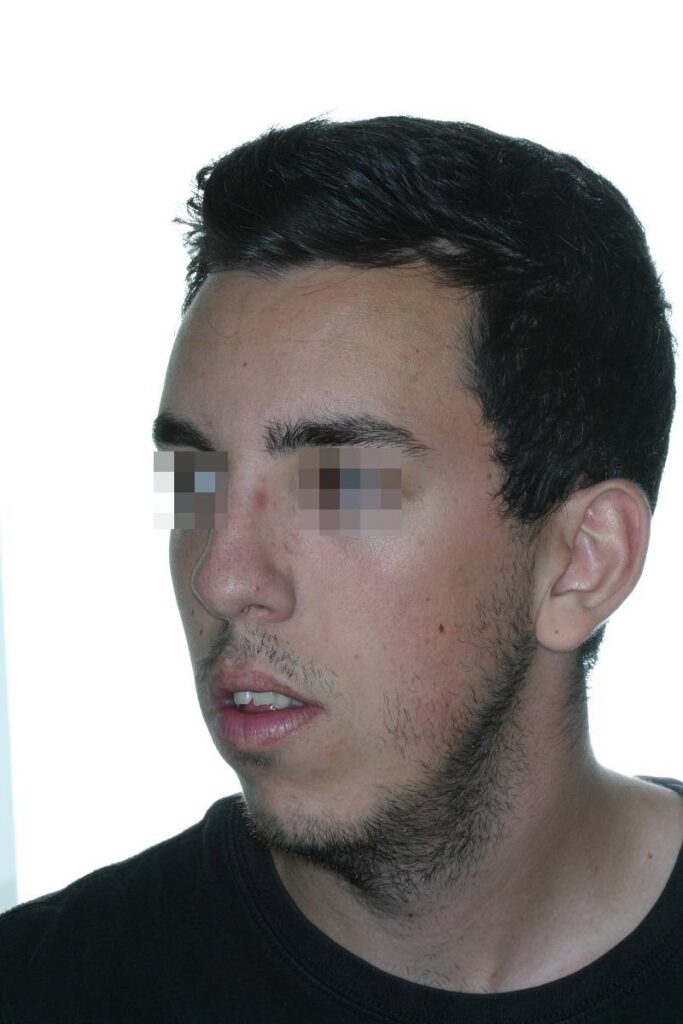 caso mordida abierta