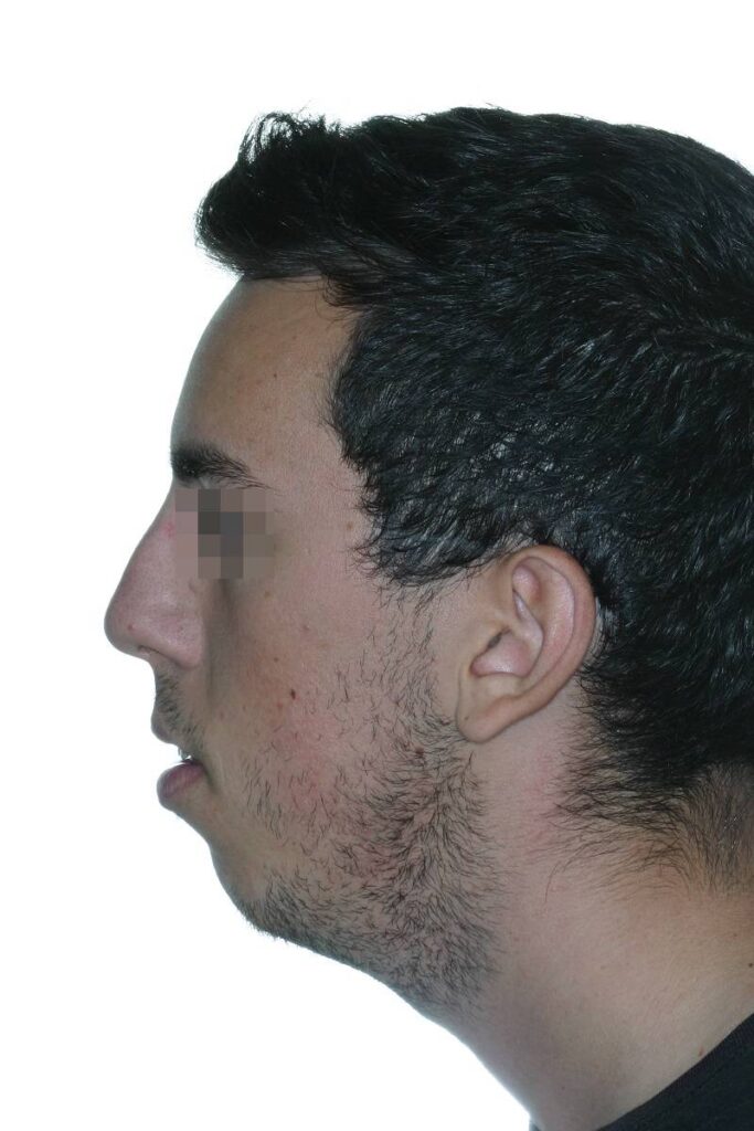 caso mordida abierta