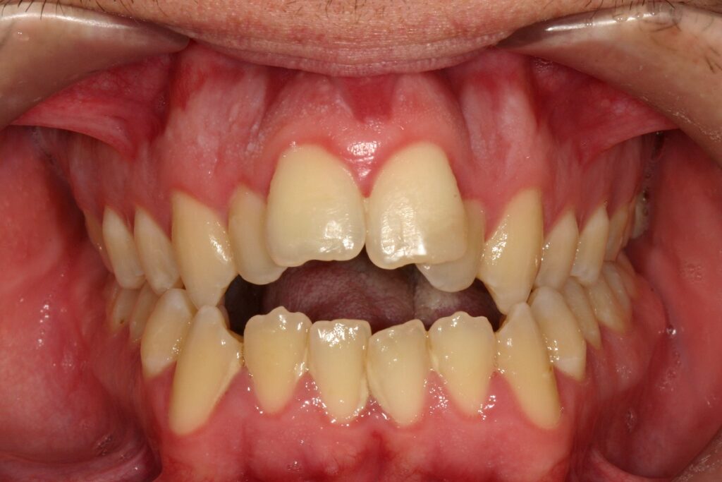 caso mordida abierta