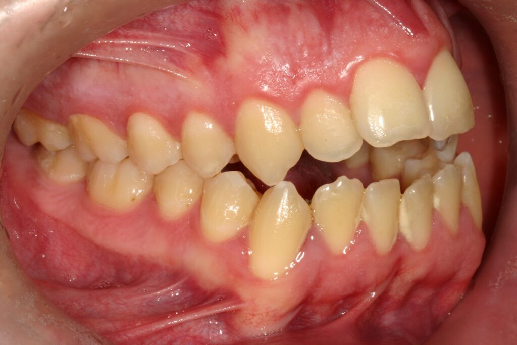 caso mordida abierta