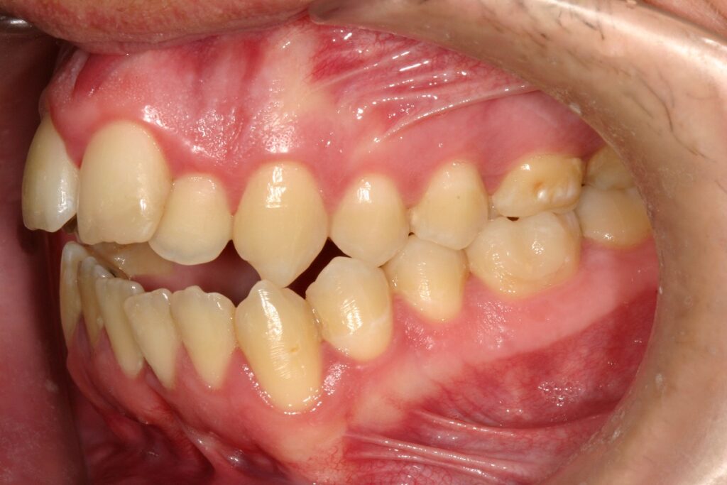 caso mordida abierta