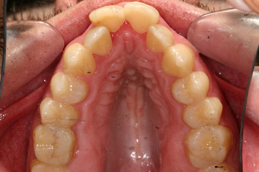 caso mordida abierta