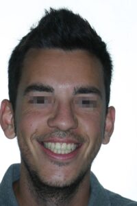 caso mordida abierta