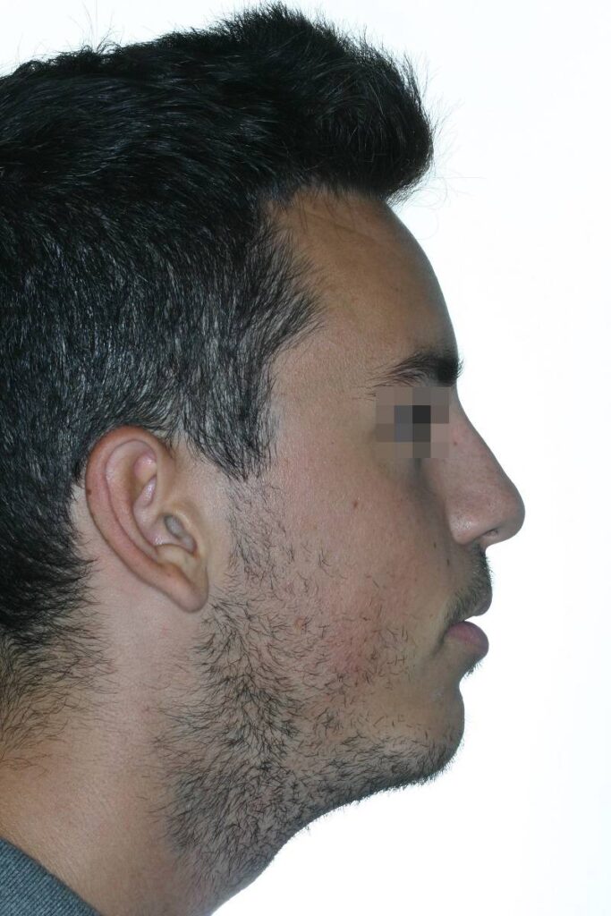 caso mordida abierta