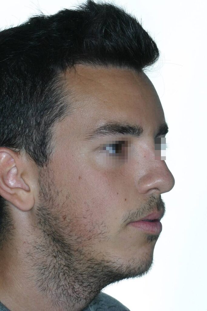 caso mordida abierta