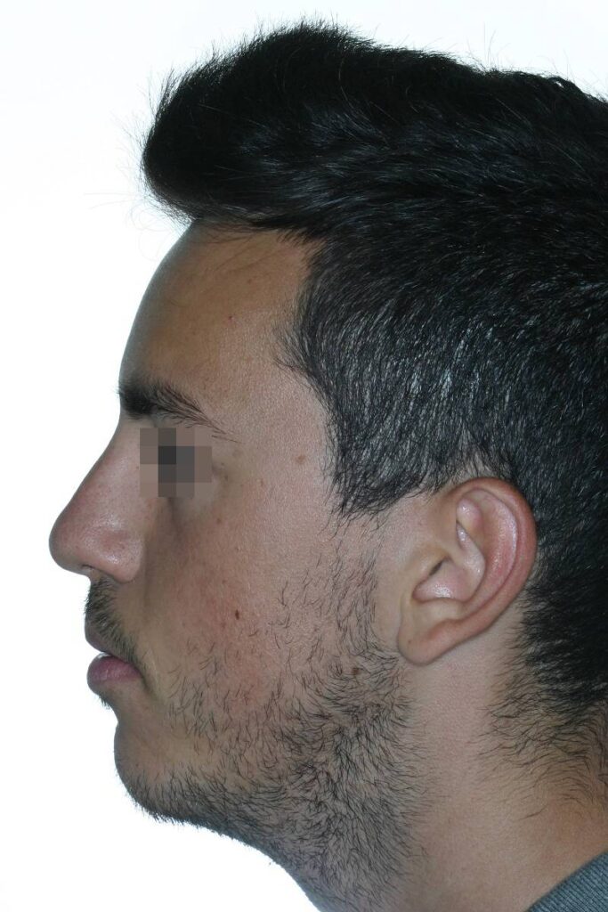 caso mordida abierta