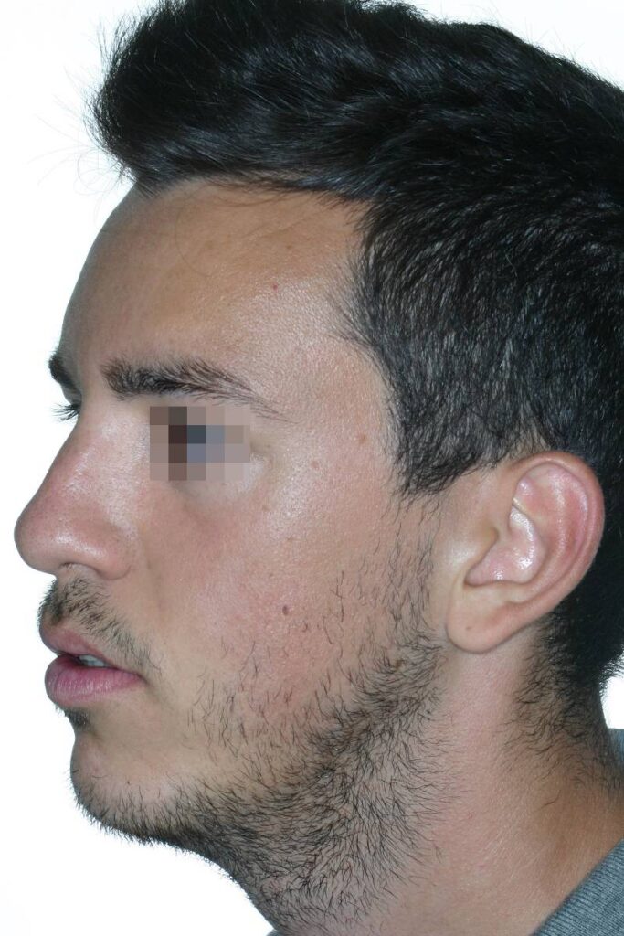 caso mordida abierta