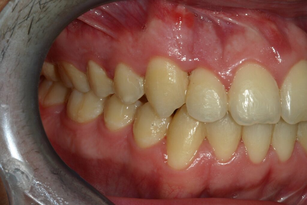 caso mordida abierta