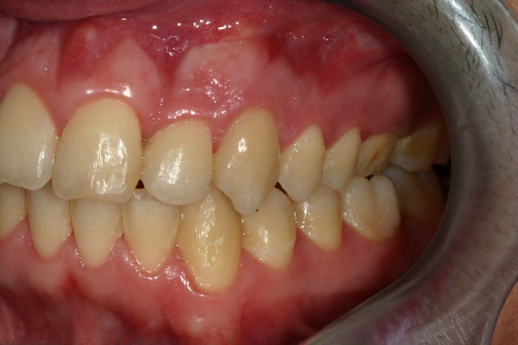 caso mordida abierta