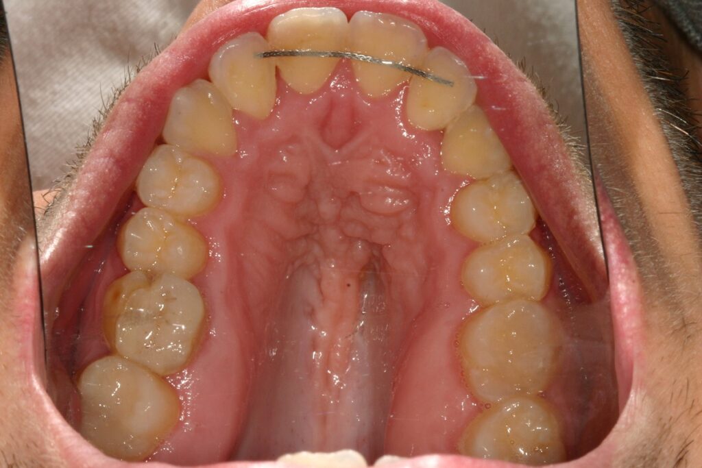caso mordida abierta