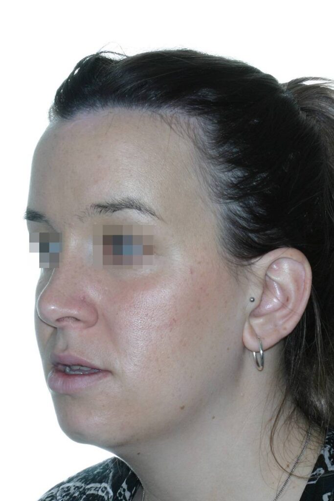 Caso clínico ortognática cumella