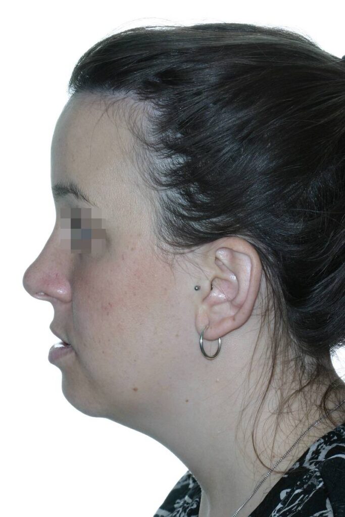 Caso clínico ortognática cumella