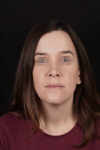 Caso clínico ortognática cumella