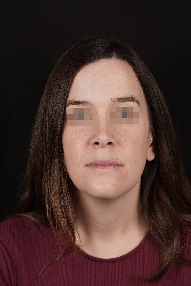 Caso clínico ortognática cumella