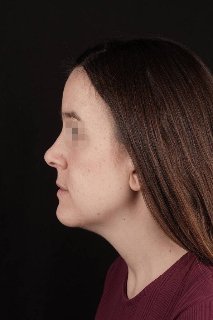 Caso clínico ortognática cumella