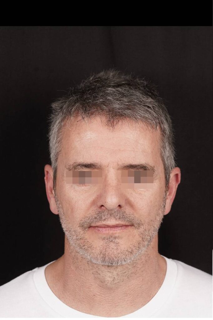 Caso clínico prótesis ángulo mandibular