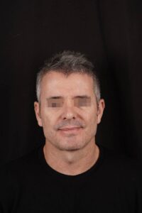 Casos clinicos protesis angulo mandibular