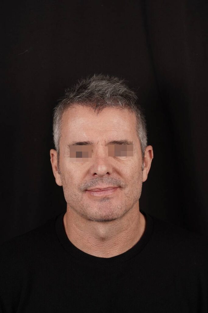 Casos clinicos protesis angulo mandibular