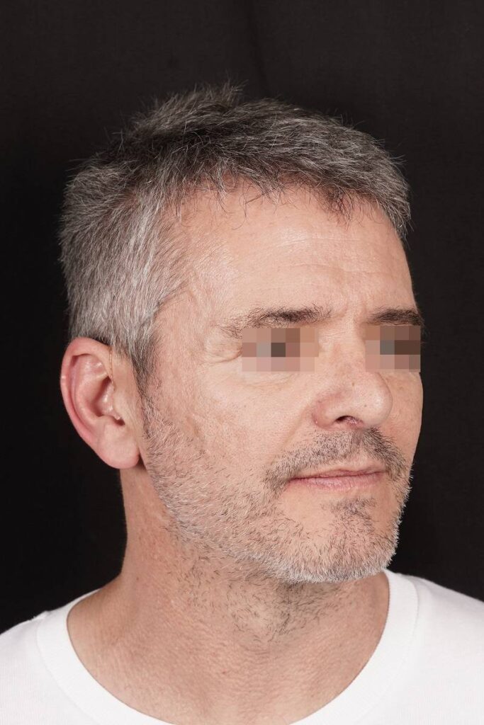 Caso clínico prótesis ángulo mandibular