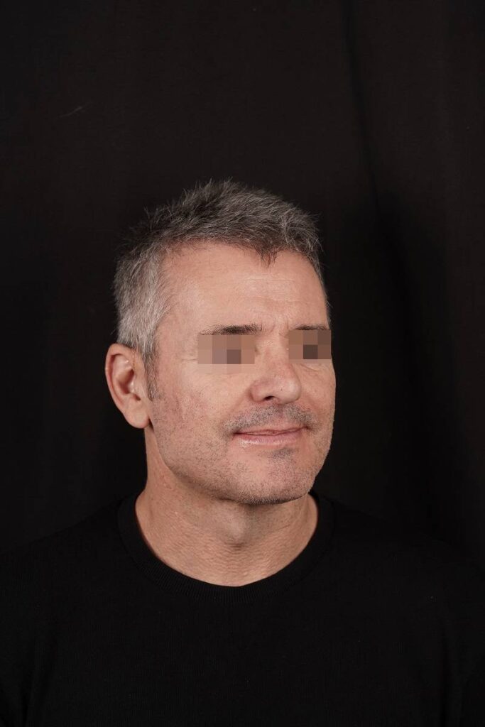 Caso clínico prótesis ángulo mandibular