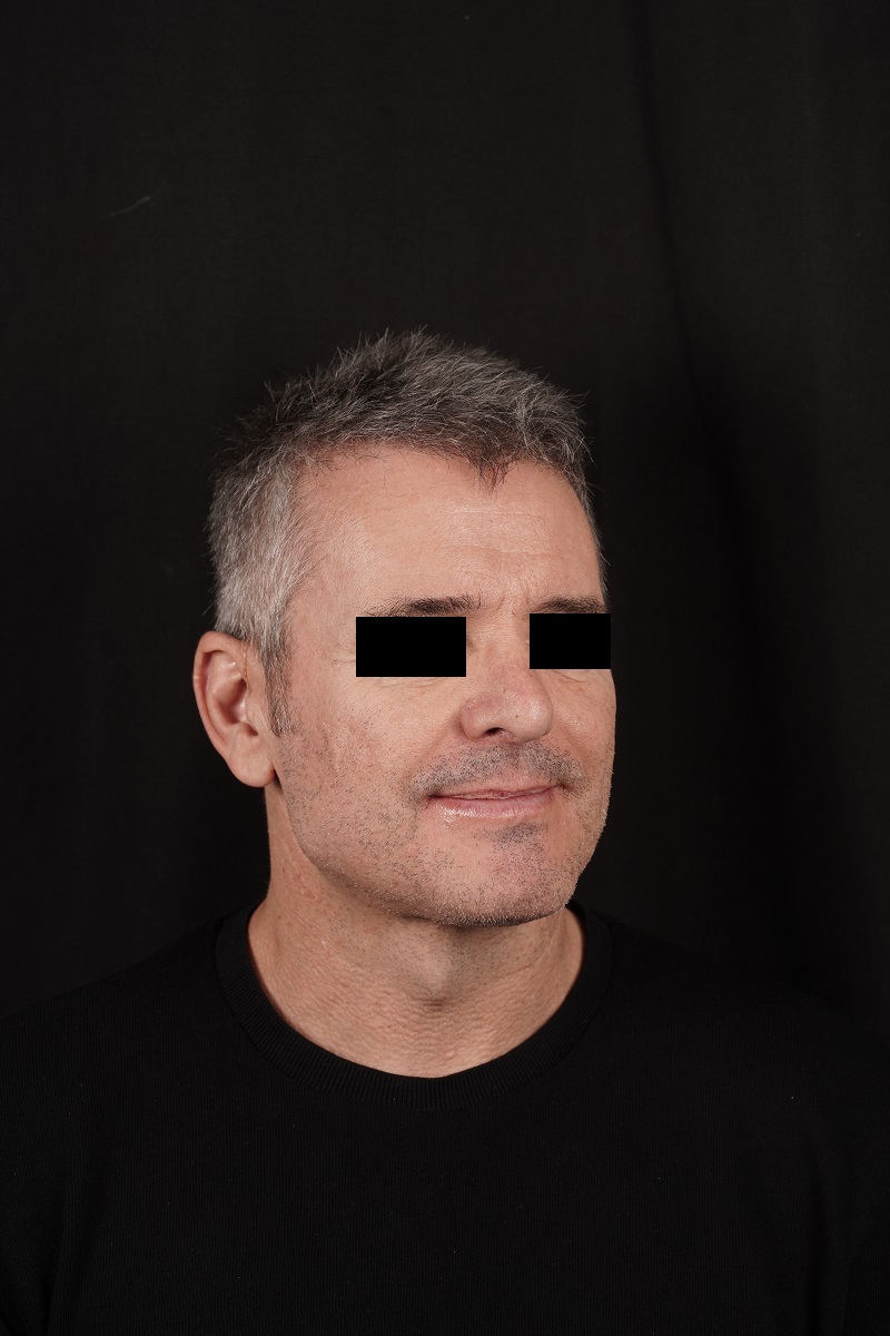 Clinical case mandibular angle prosthesis - Birbe Clinic - Contact us