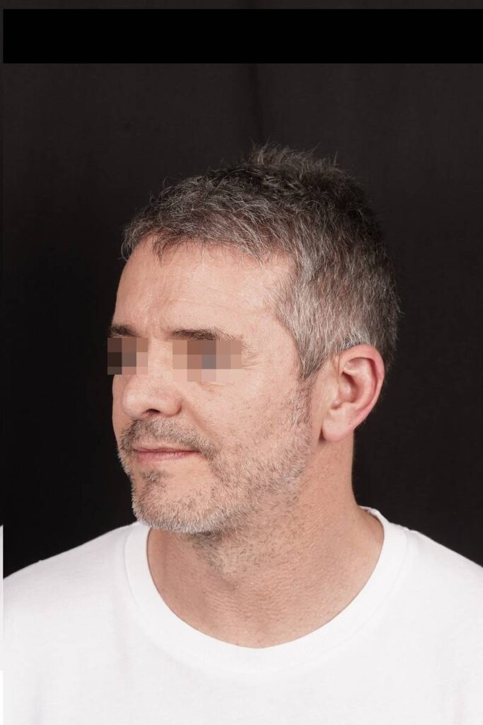 Caso clínico prótesis ángulo mandibular