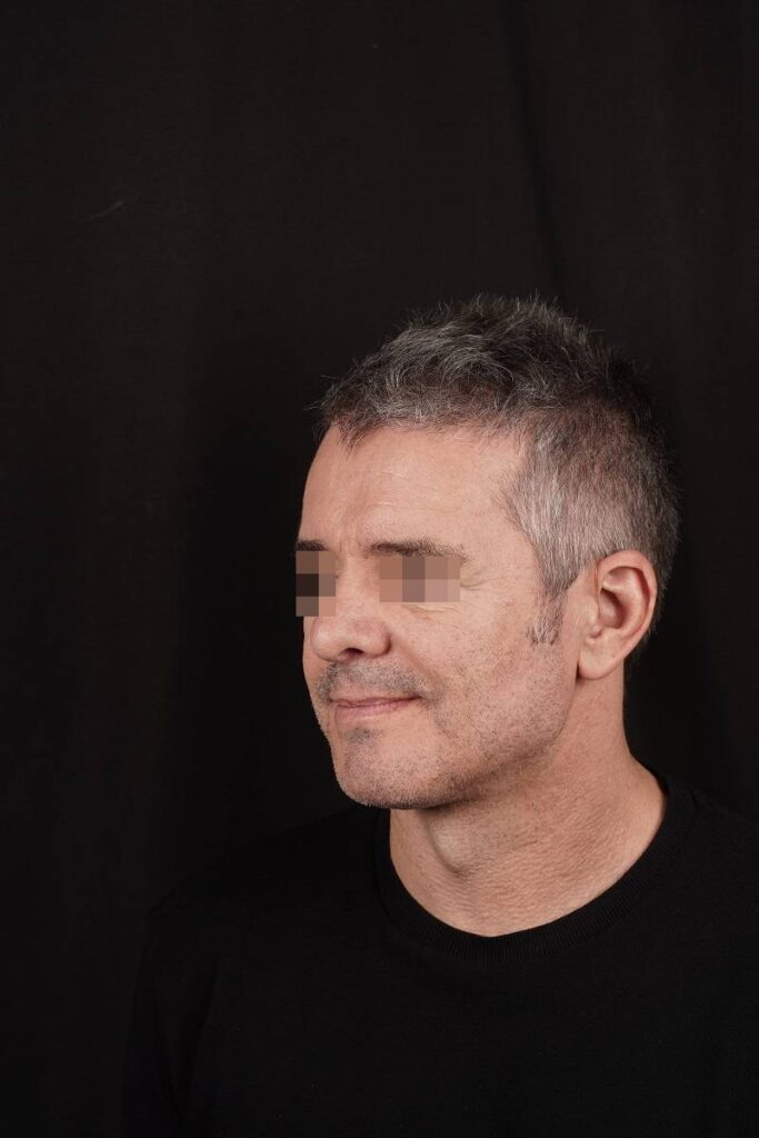 Caso clínico prótesis ángulo mandibular