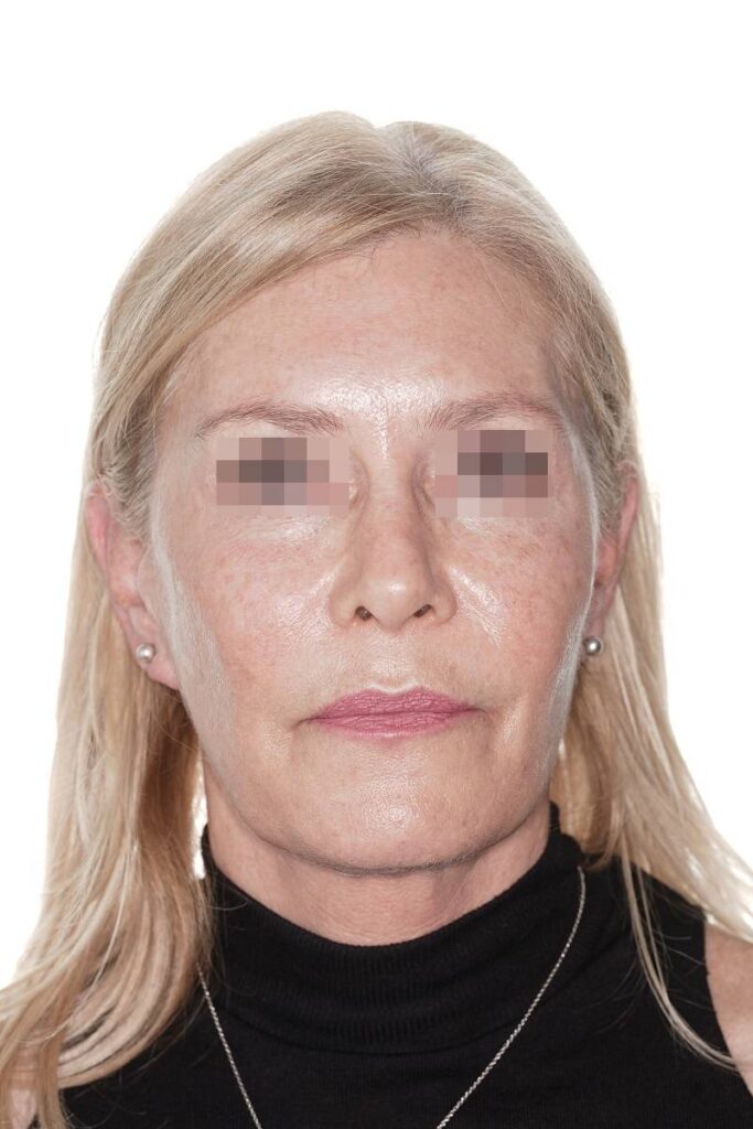 Caso clínico lifting de contorno mandibular