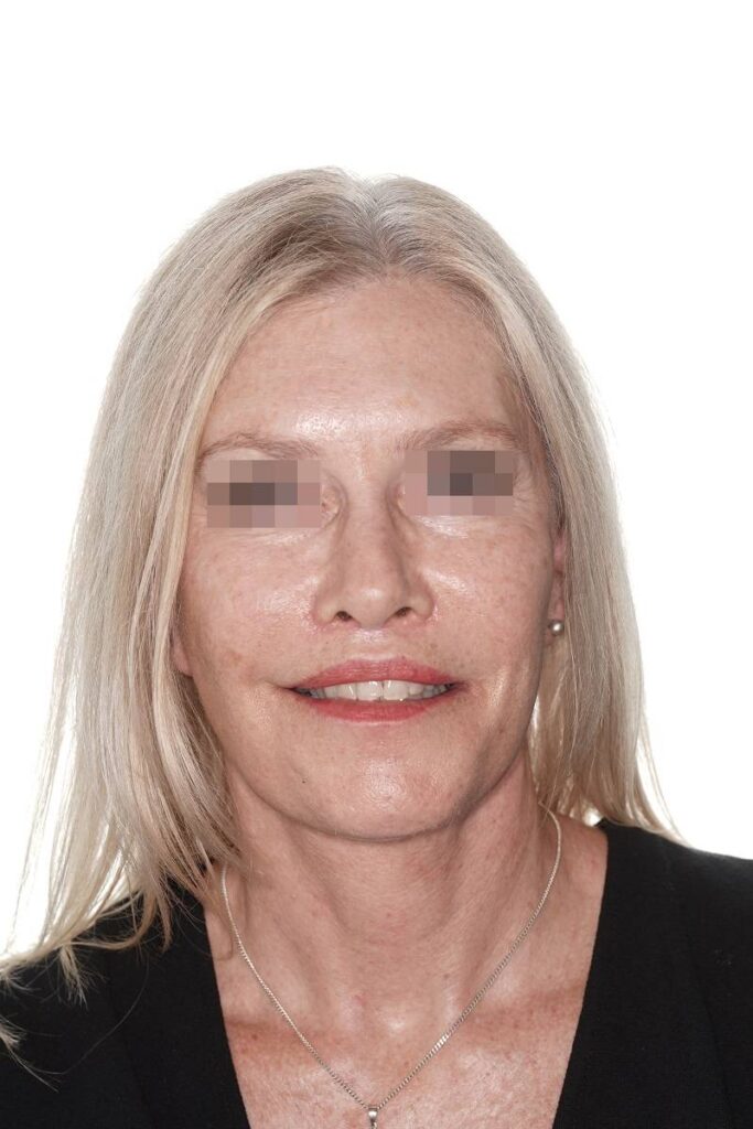 Casos clínicos lifting facial