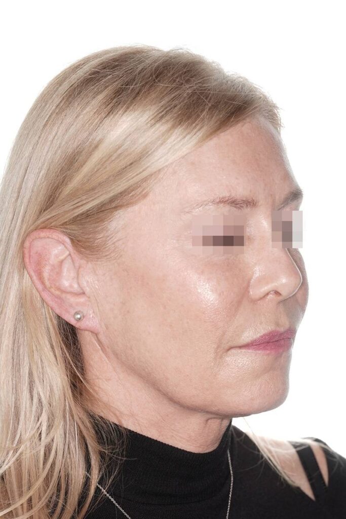 Caso clínico lifting de contorno mandibular