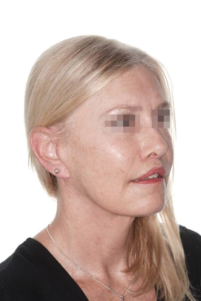 Caso clínico lifting de contorno mandibular