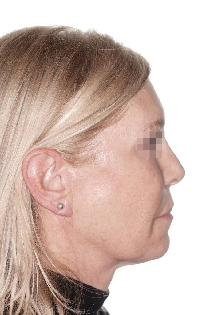 Caso clínico lifting de contorno mandibular