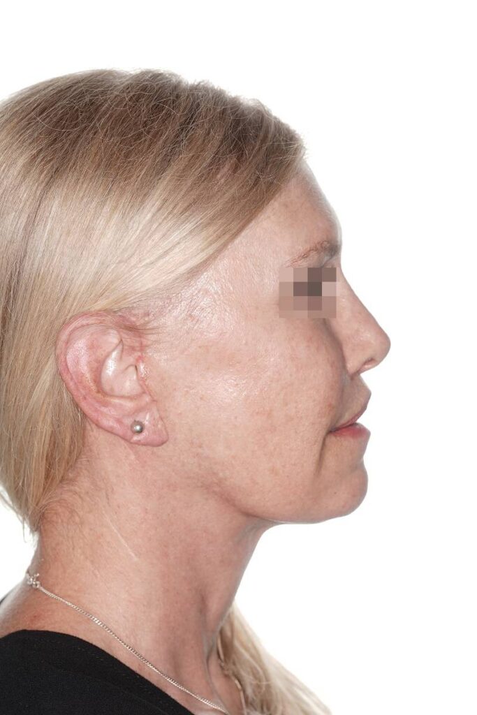 Caso clínico lifting de contorno mandibular