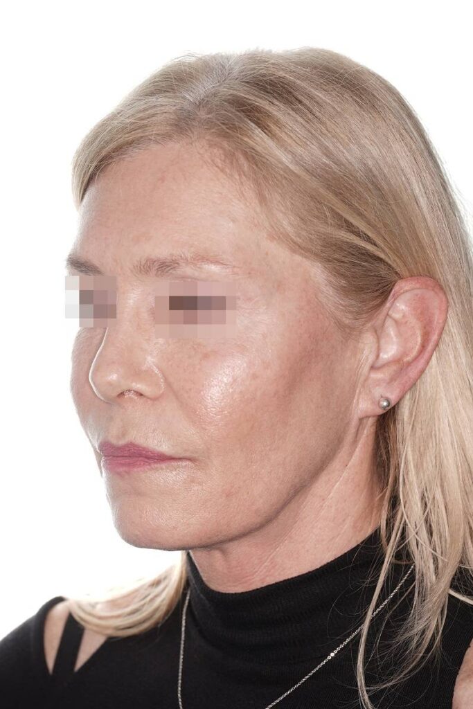 Caso clínico lifting de contorno mandibular