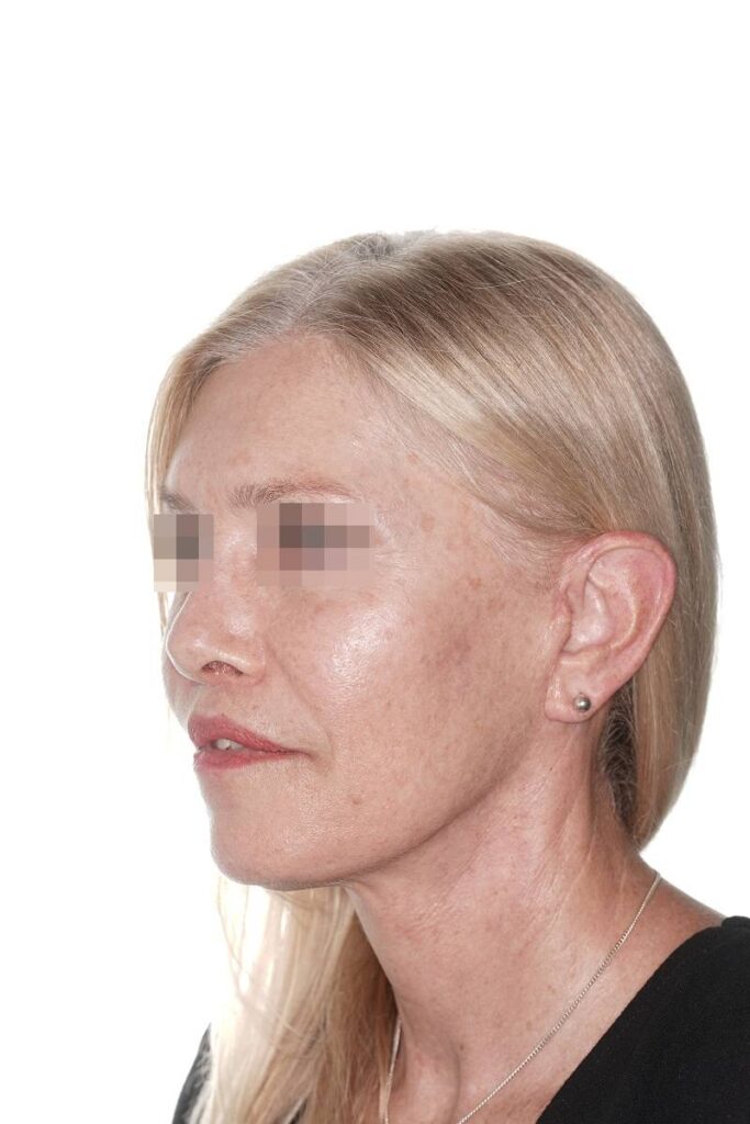 Caso clínico lifting de contorno mandibular