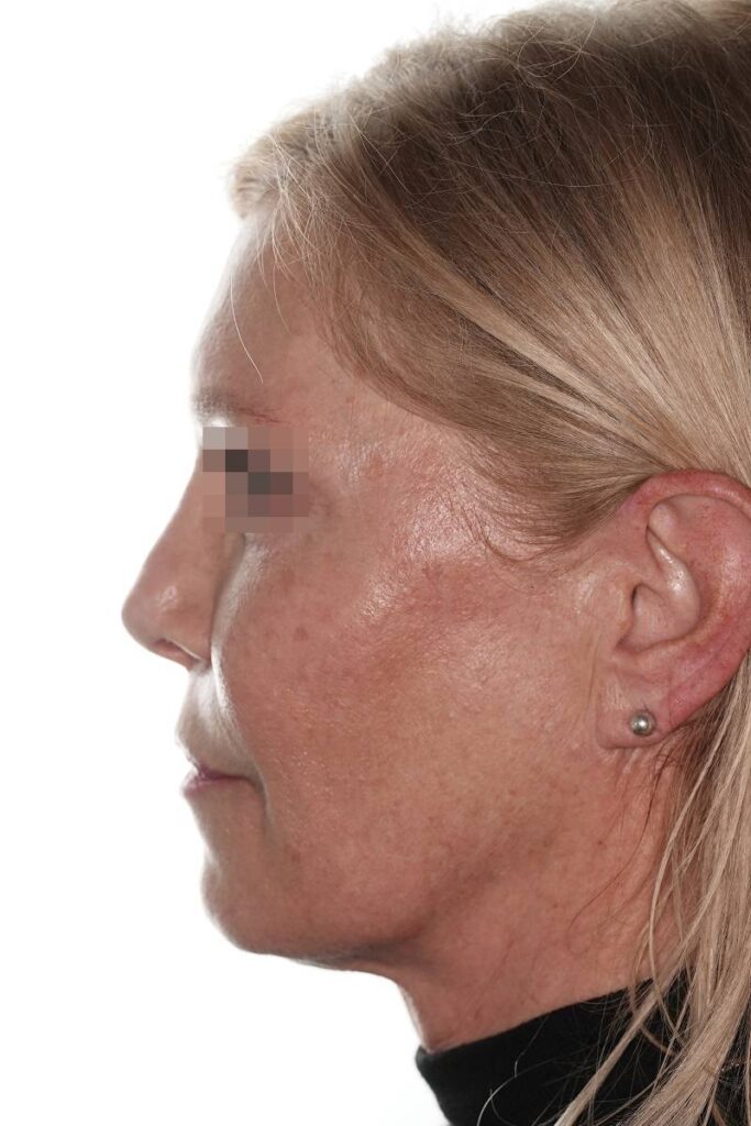 Caso clínico lifting de contorno mandibular