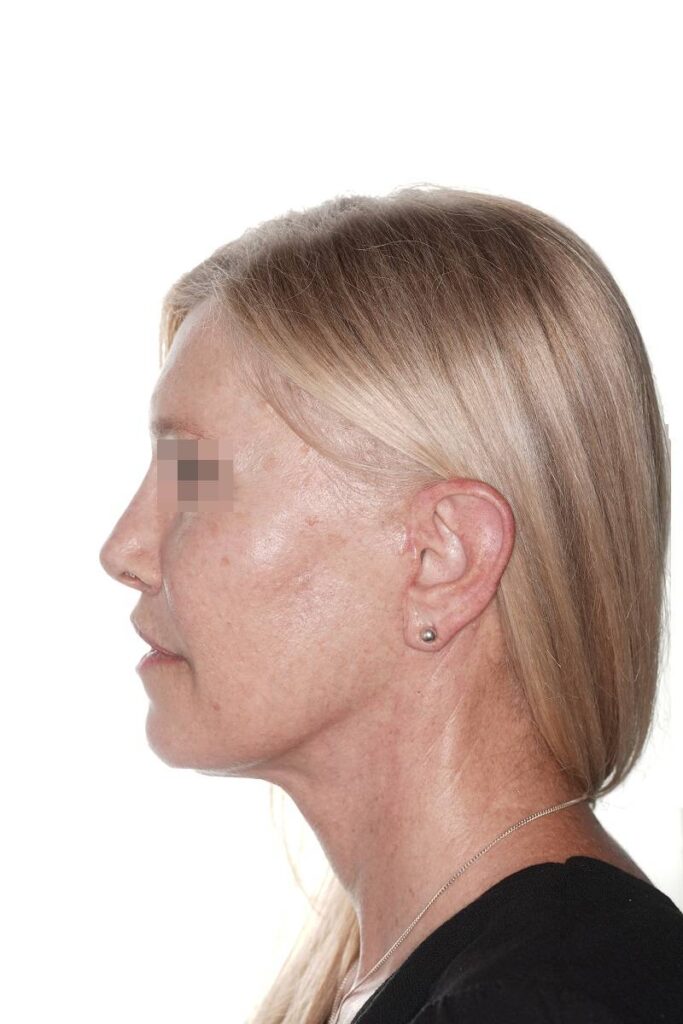 Caso clínico lifting de contorno mandibular