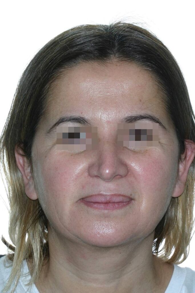 Caso clínico lifting de cara