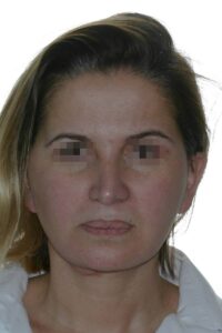 Caso clínico lifting de cara