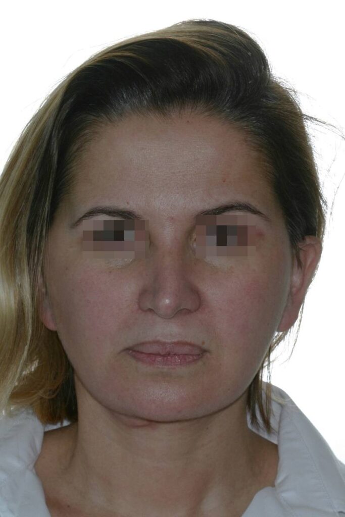 Caso clínico lifting de cara