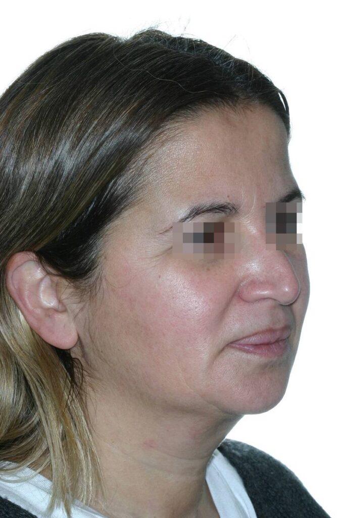 Caso clínico lifting de cara