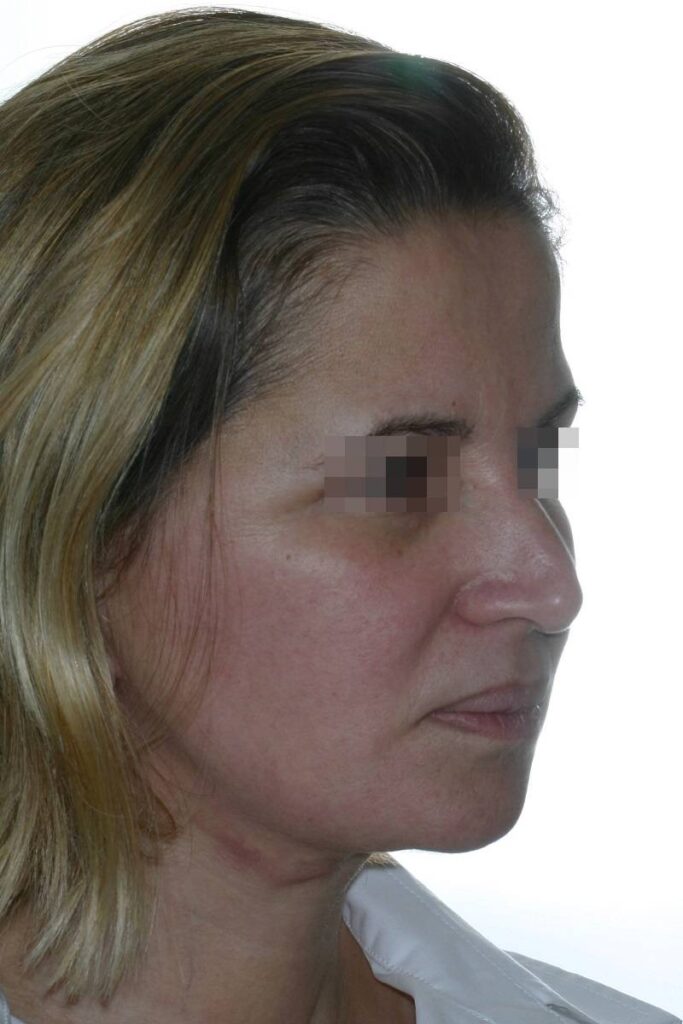 Caso clínico lifting de cara