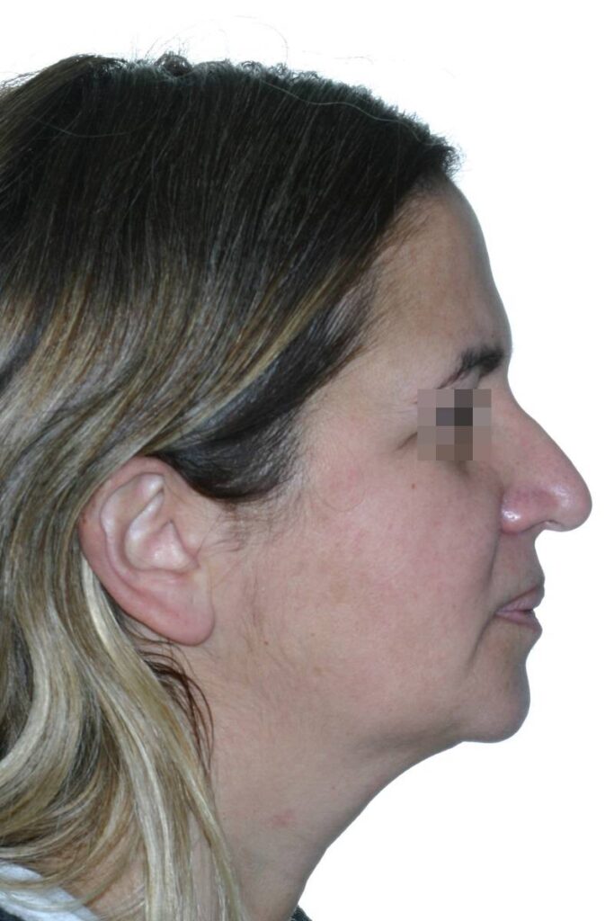 Caso clínico lifting de cara