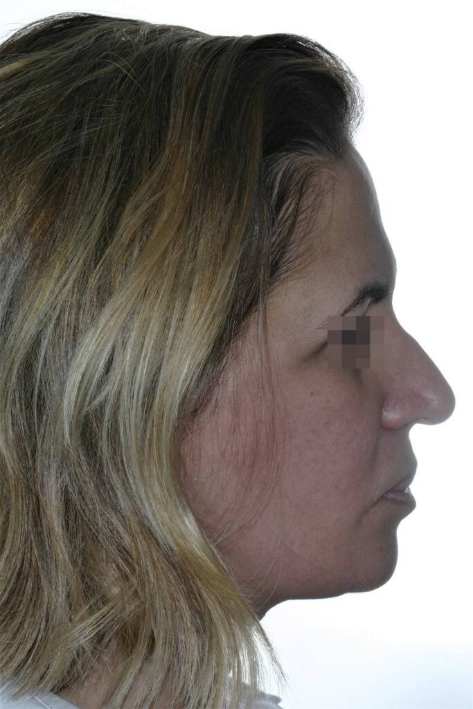 Caso clínico lifting de cara