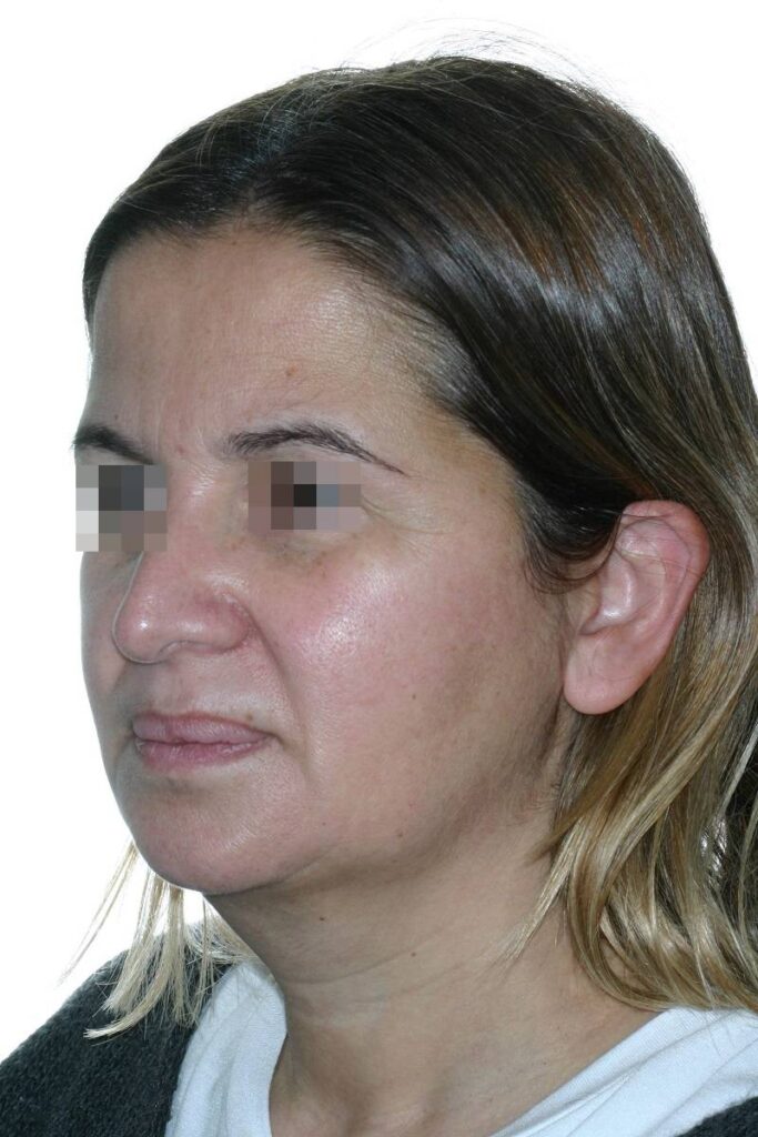 Caso clínico lifting de cara