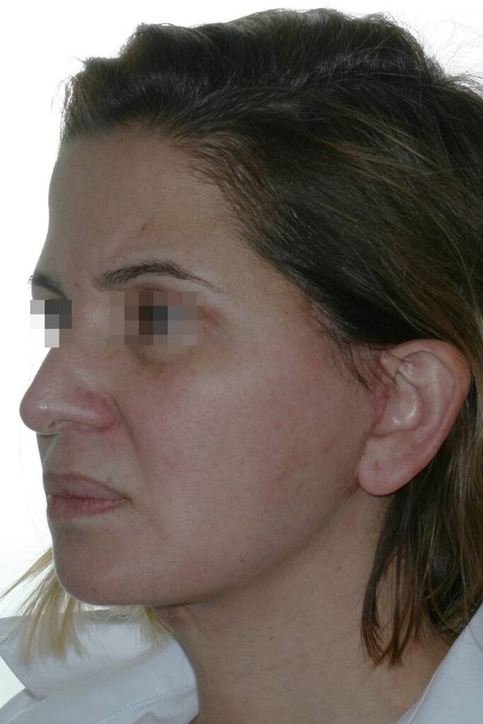 Caso clínico lifting de cara